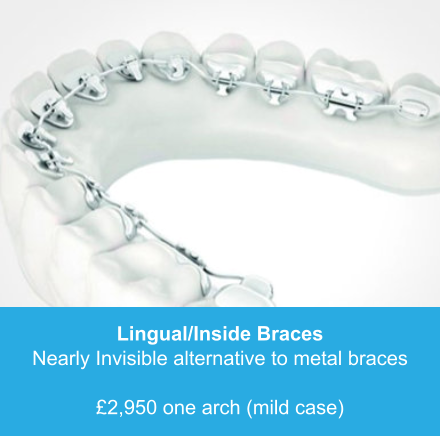 Lingual/Inside Braces Nearly Invisible alternative to metal braces  £2,950 one arch (mild case)