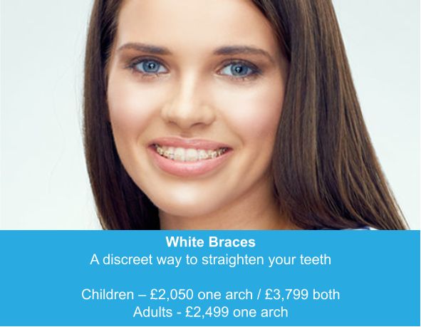 White Braces A discreet way to straighten your teeth  Children – £2,050 one arch / £3,799 both Adults - £2,499 one arch