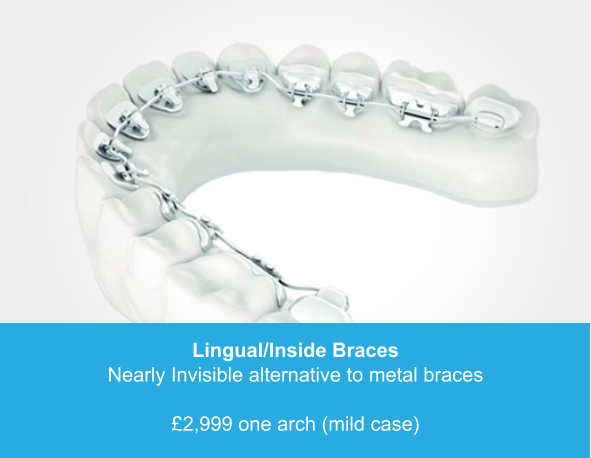 Lingual/Inside Braces Nearly Invisible alternative to metal braces  £2,999 one arch (mild case)