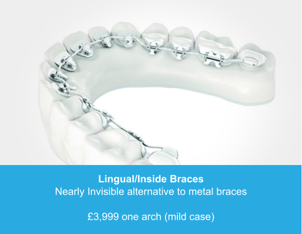 Lingual/Inside Braces Nearly Invisible alternative to metal braces  £3,999 one arch (mild case)