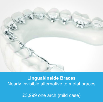Lingual/Inside Braces Nearly Invisible alternative to metal braces  £3,999 one arch (mild case)