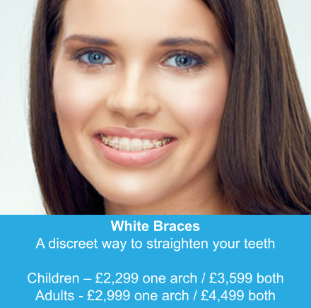 White Braces A discreet way to straighten your teeth  Children – £2,299 one arch / £3,599 both Adults - £2,999 one arch / £4,499 both